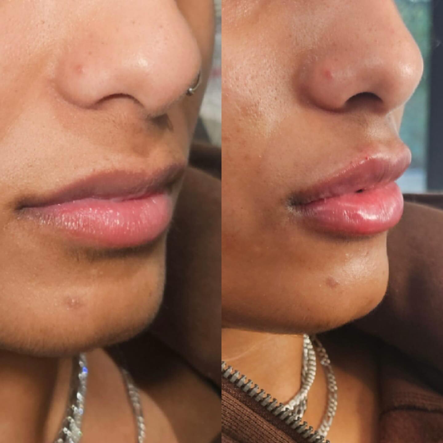 Lip injections before and after