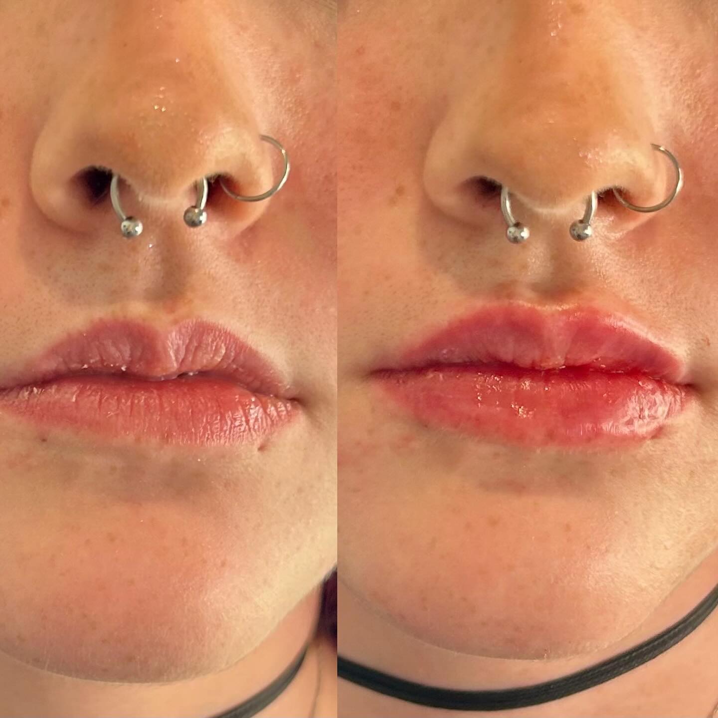 plump lips after filler frisco