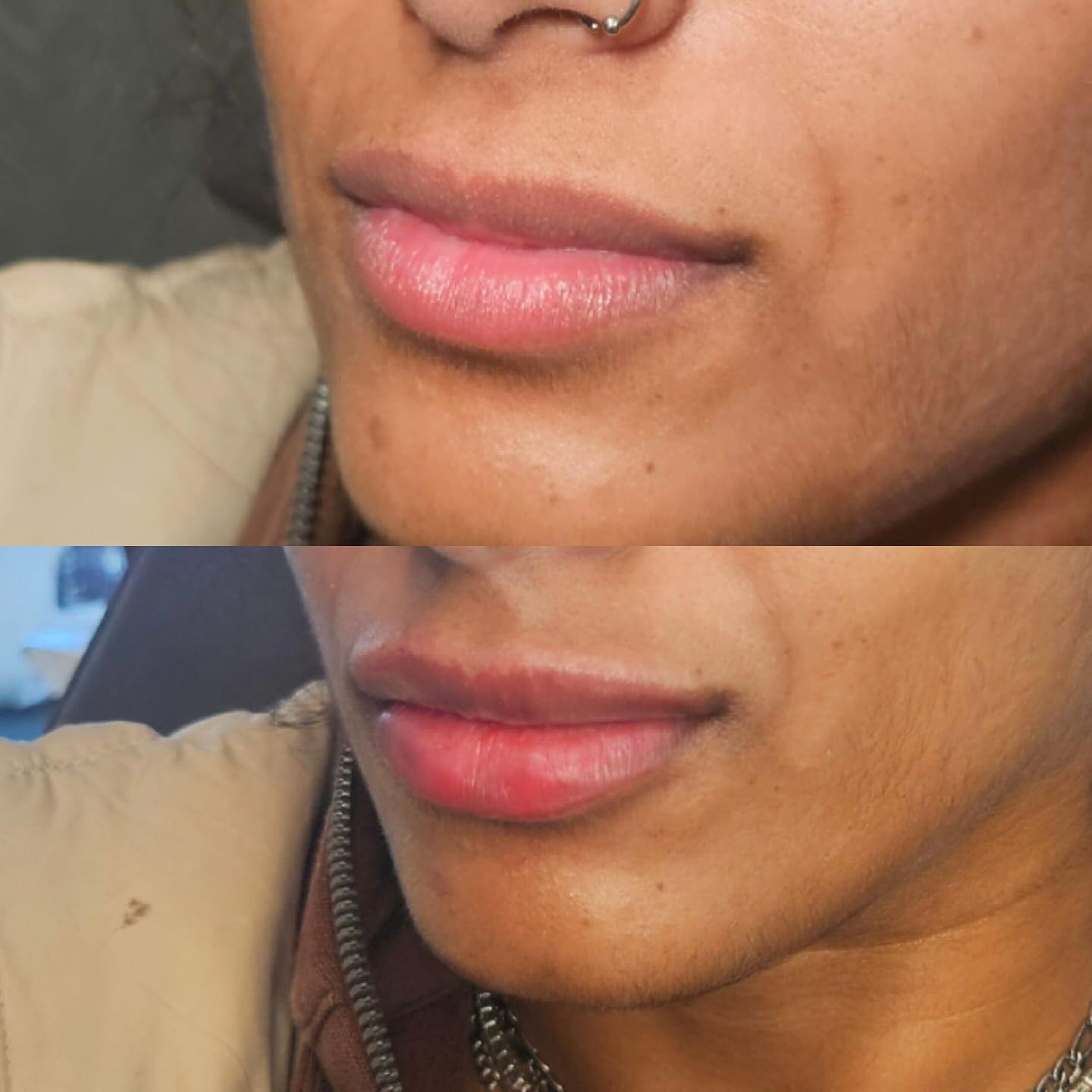before and after filler in lips frisco tx