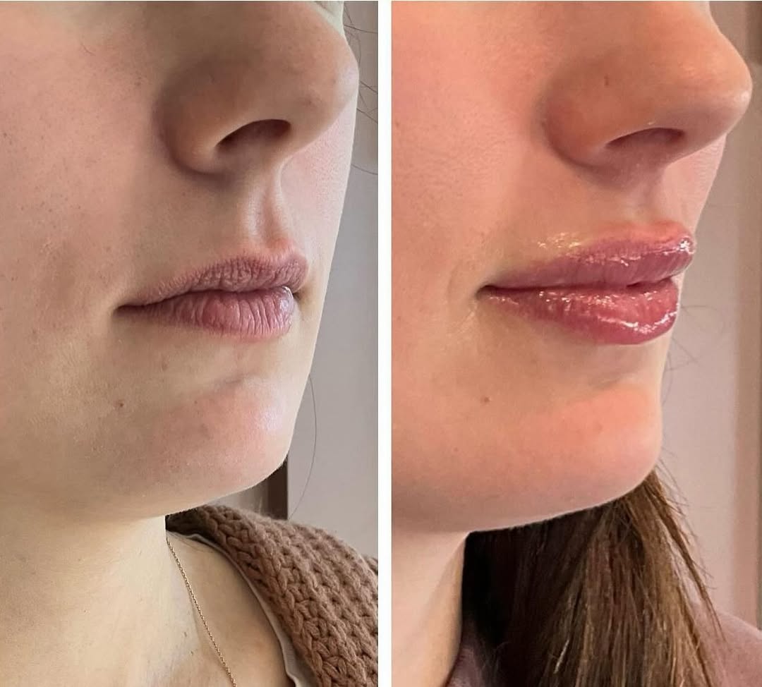 lip filler service