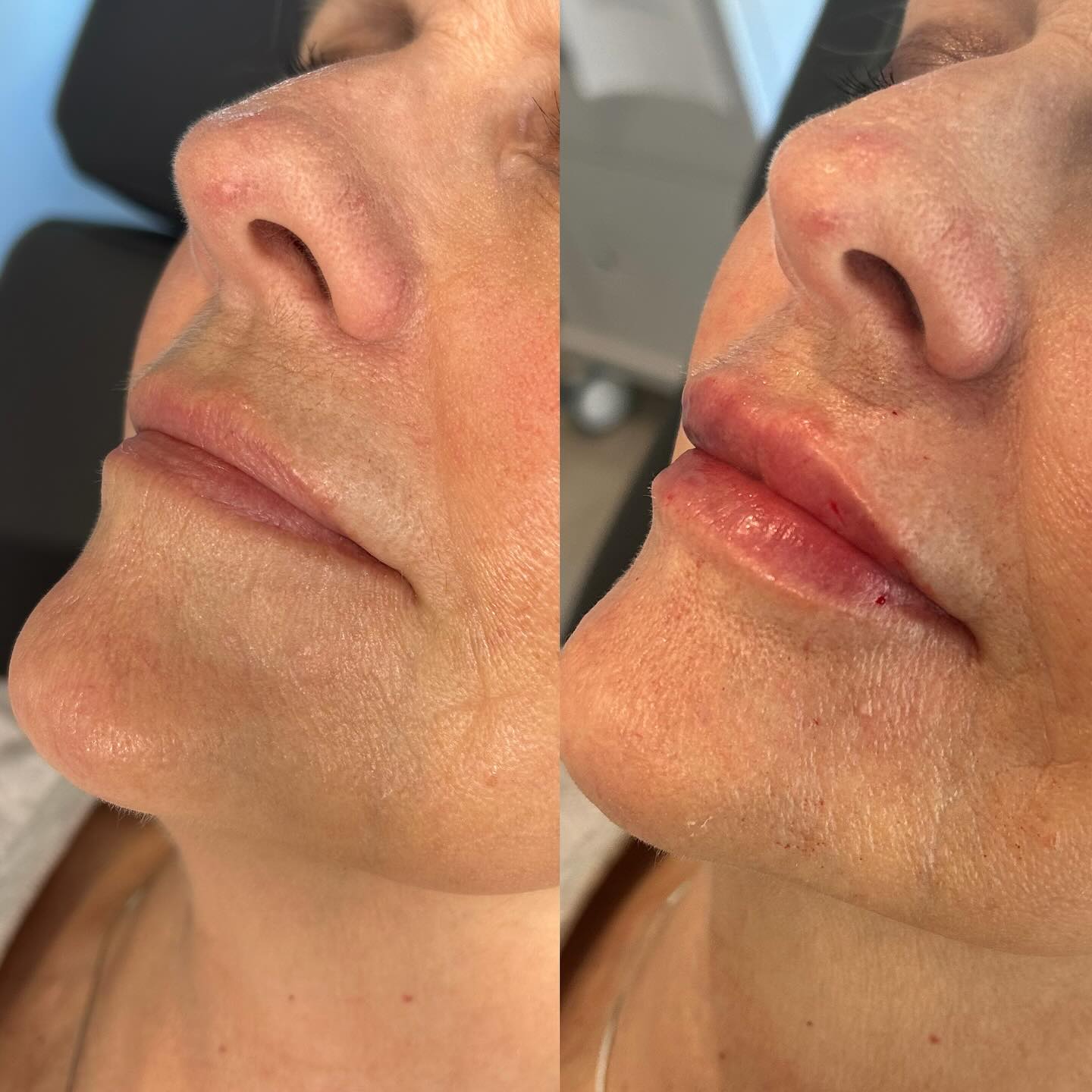 Lip Filler Frisco Tx