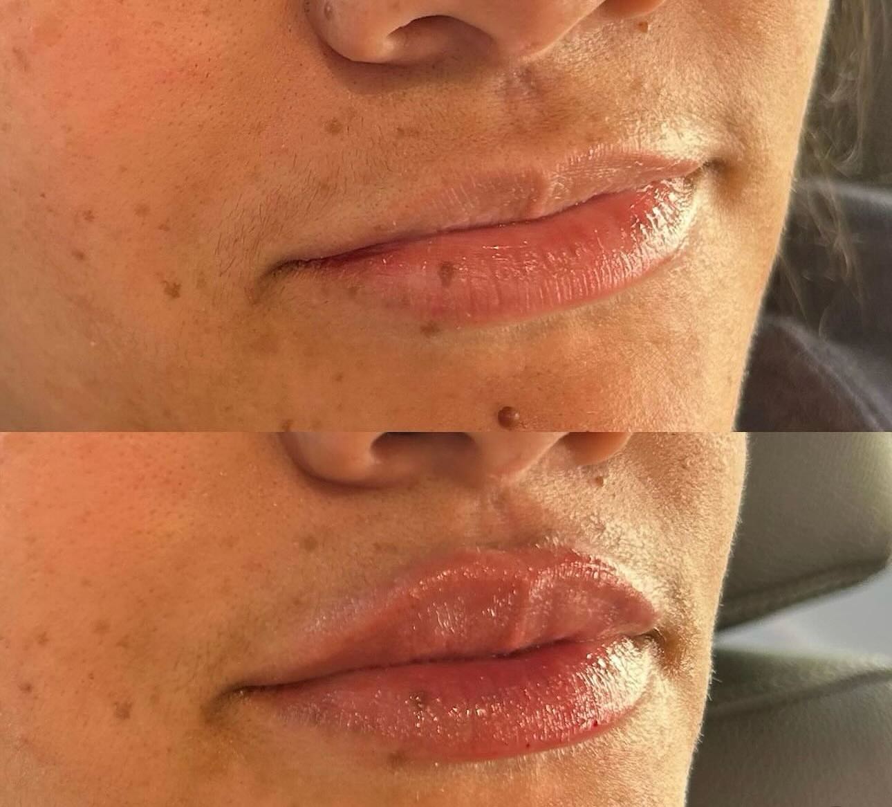 Lips before and after filler in frisco
