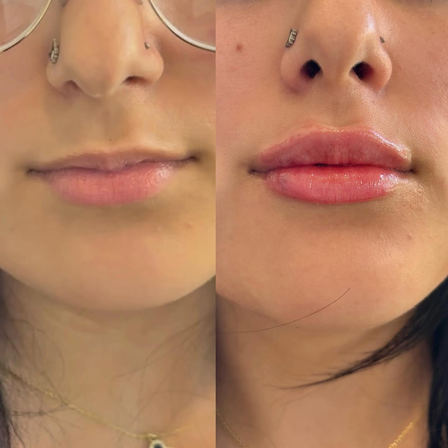 lip filler