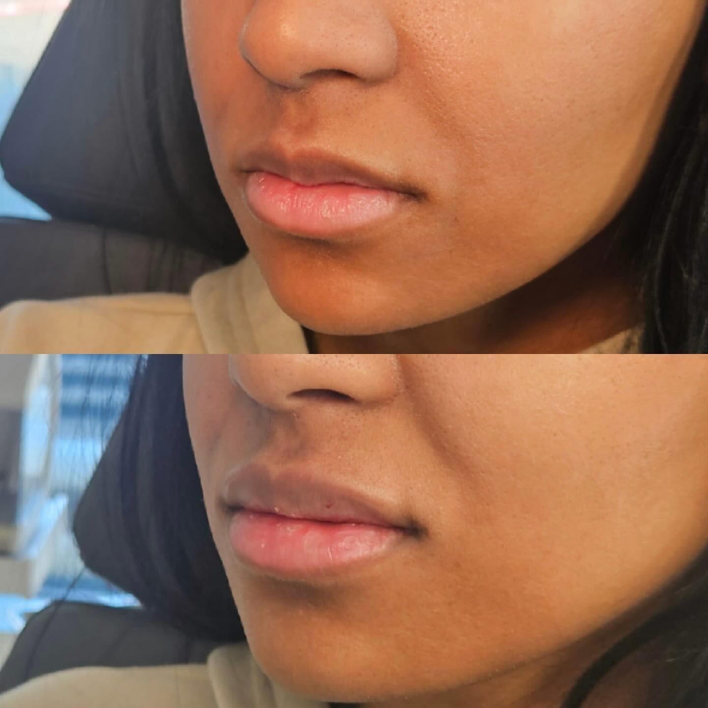 before and after lip filler frisco