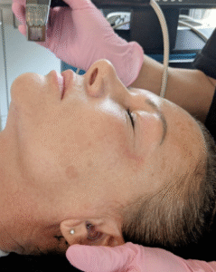 rf microneedling