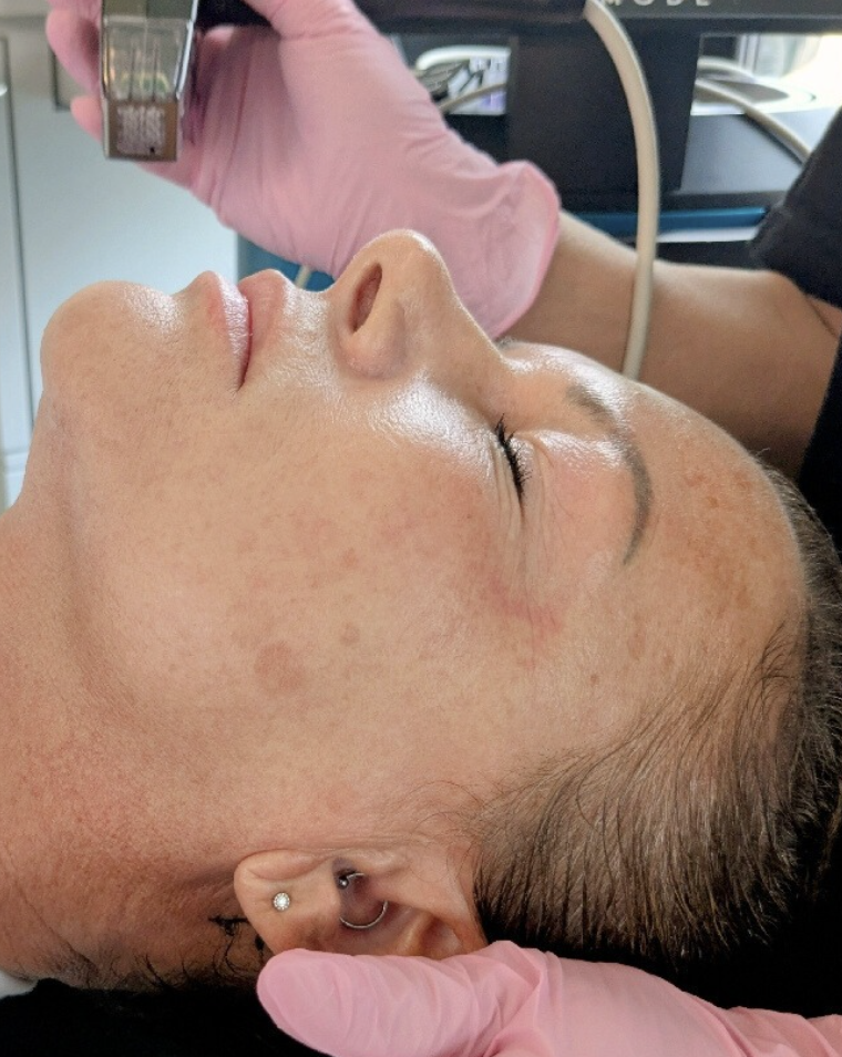 rf microneedling