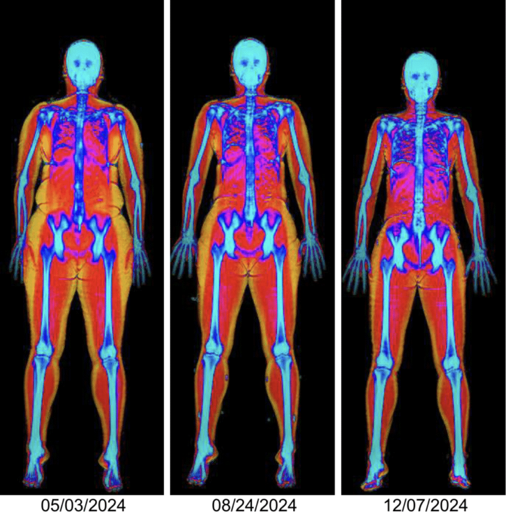 Dexa Scan Result Dexa Scan Result
