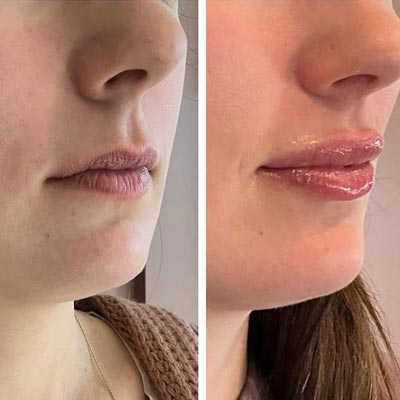 Before and After Photos of Revive Health and Beauty in Frisco, TX