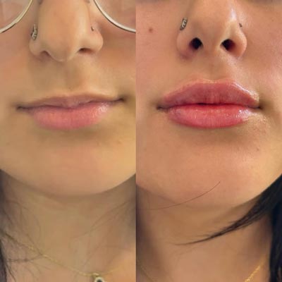 Before and After Photos of Revive Health and Beauty in Frisco, TX