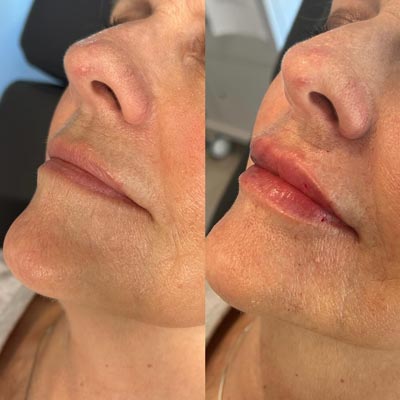 Before and After Photos of Revive Health and Beauty in Frisco, TX