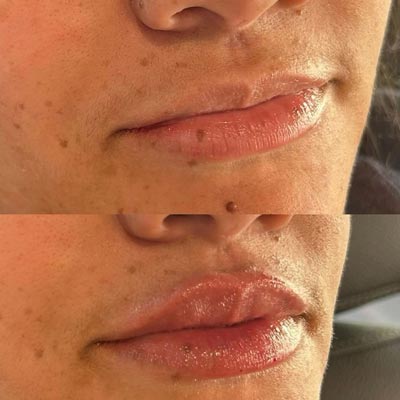 Before and After Photos of Revive Health and Beauty in Frisco, TX