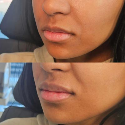 Before and After Photos of Revive Health and Beauty in Frisco, TX