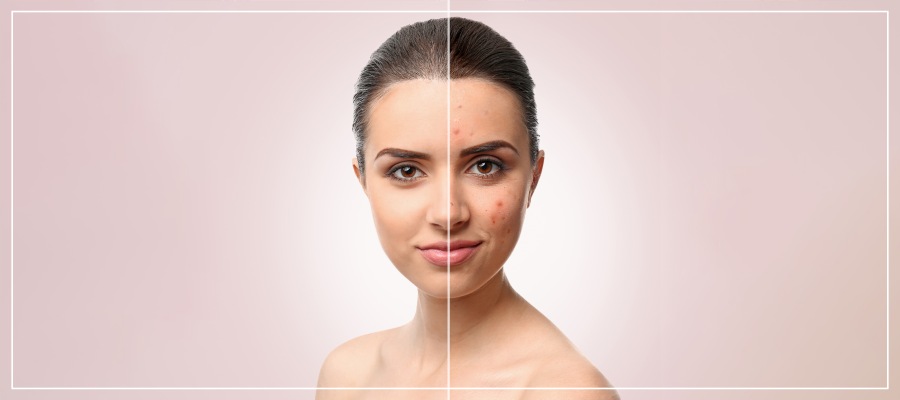 Acne Facial Treatment Specialist Near Me in Frisco, TX Acne Facial Treatment Specialist Near Me in Frisco, TX