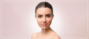 Acne Facial Treatment Specialist Near Me in Frisco, TX Acne Facial Treatment Specialist Near Me in Frisco, TX