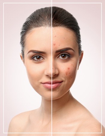 Acne Facial Near Me in Frisco, TX